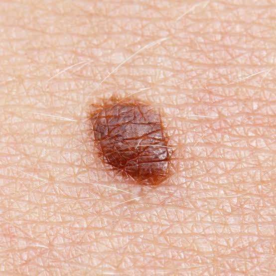 Karsinoma Sel Basal