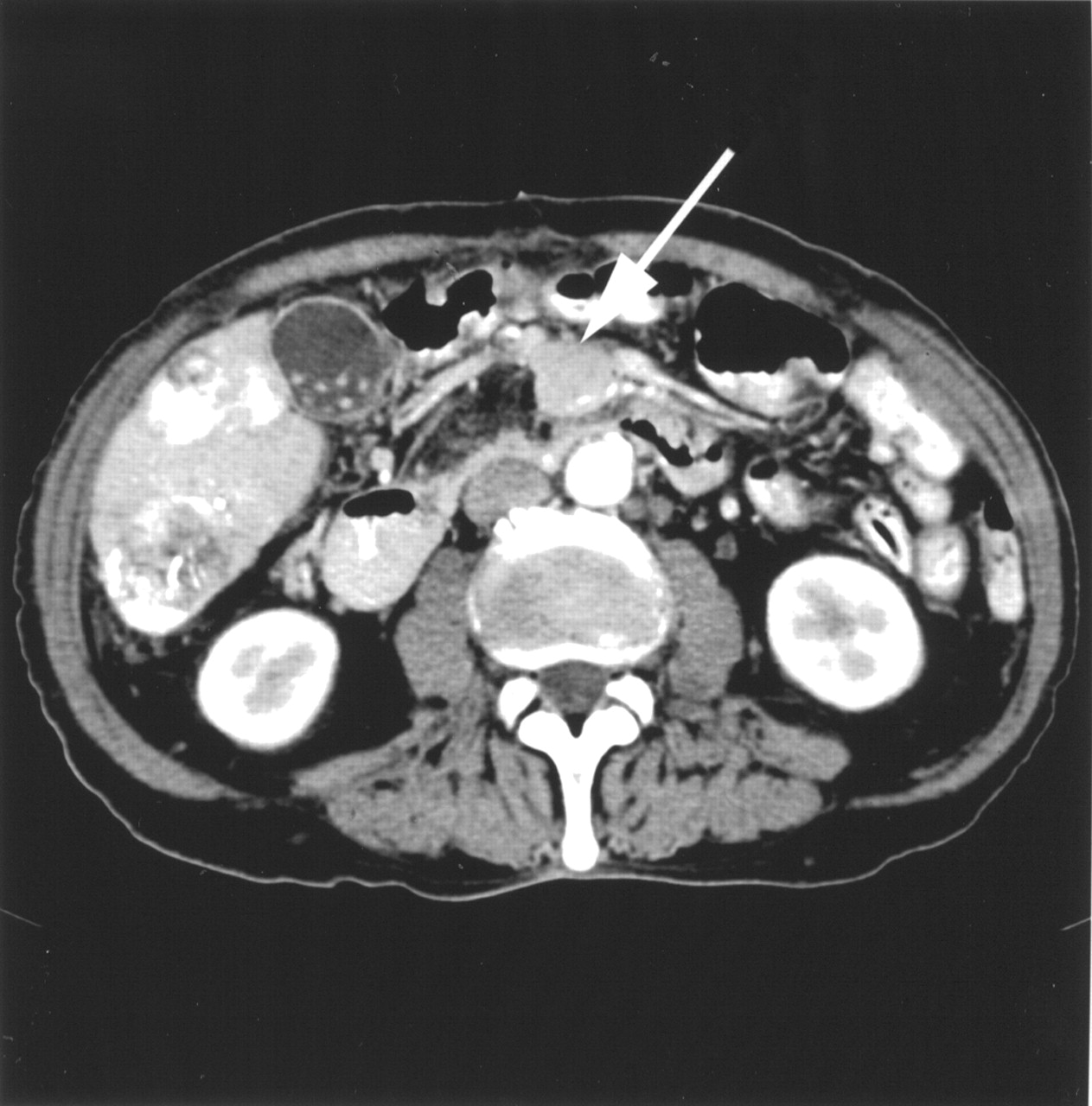 Tumor Karsinoid