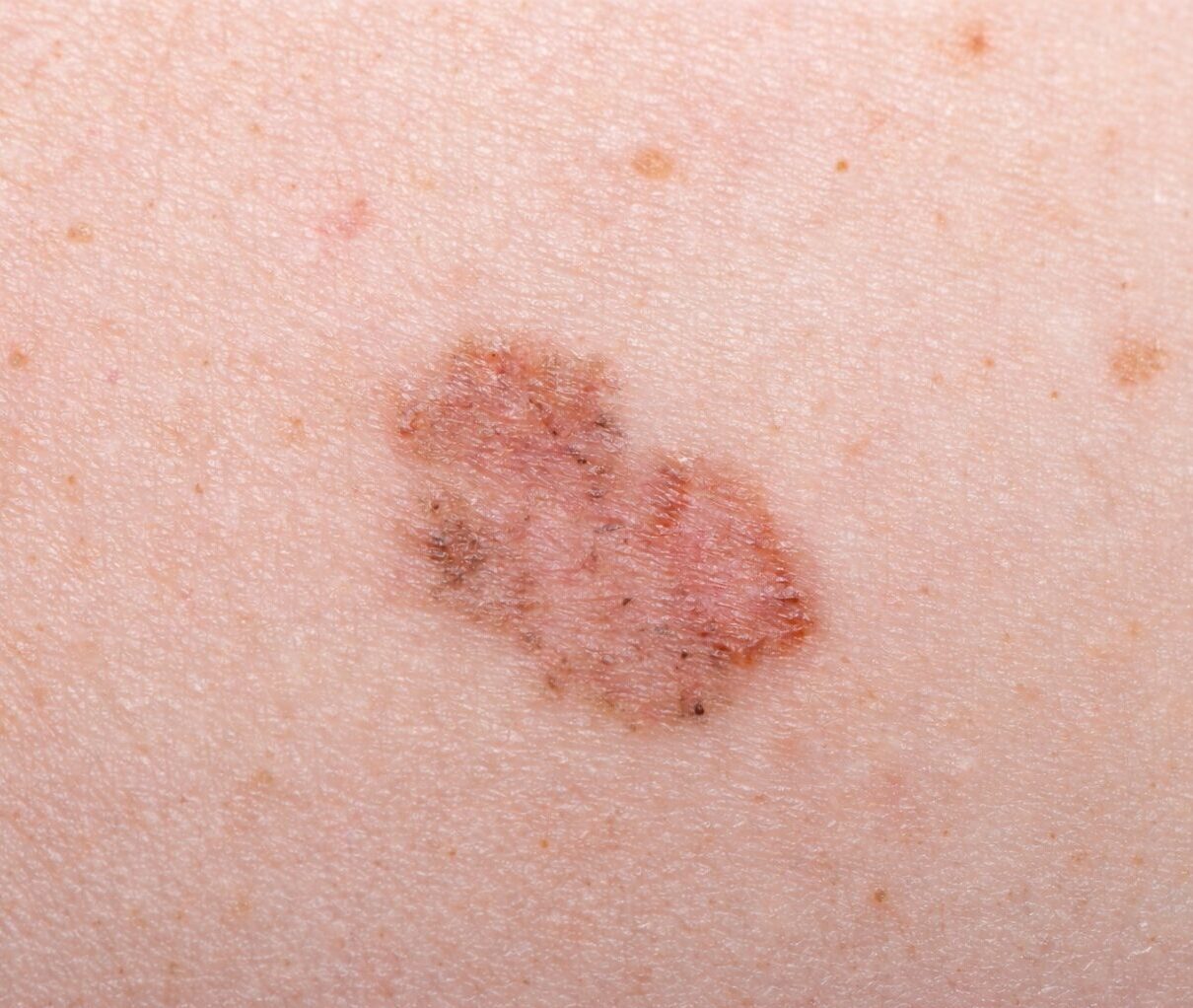 Karsinoma Sel Basal