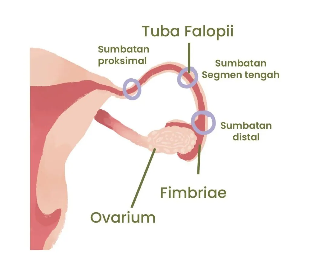 Tuba Falopi