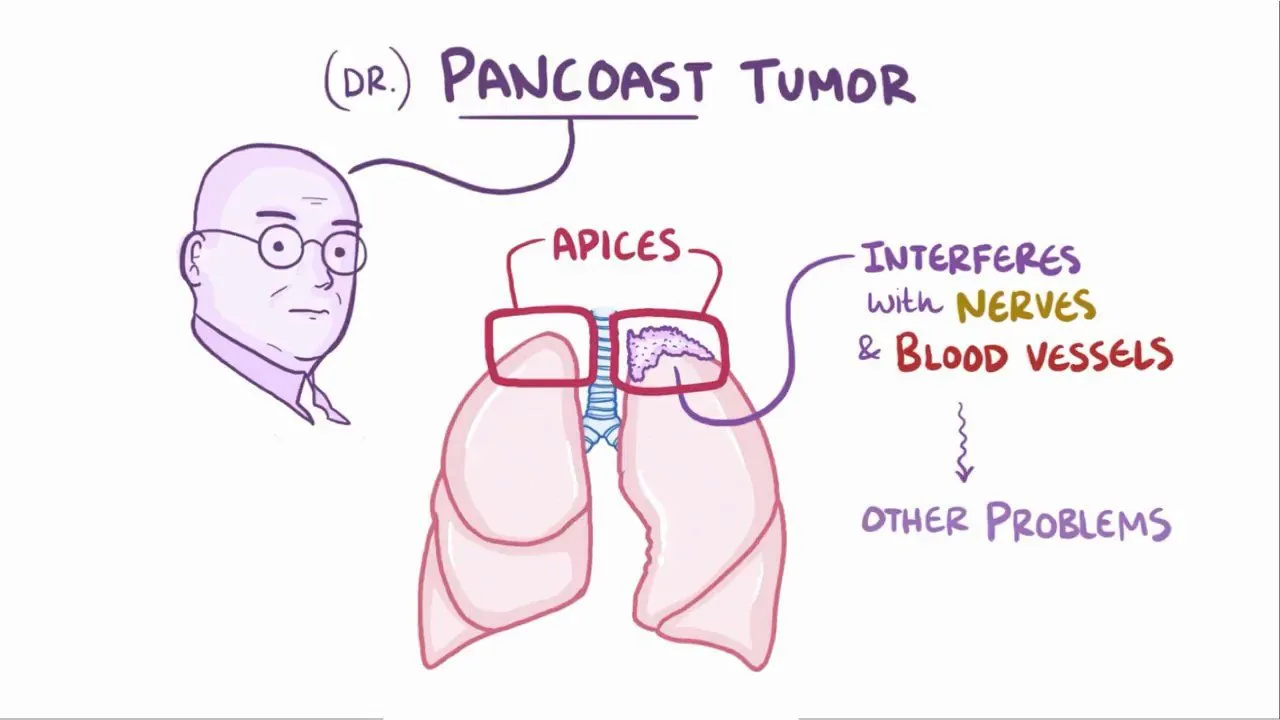 Tumor Pancoast