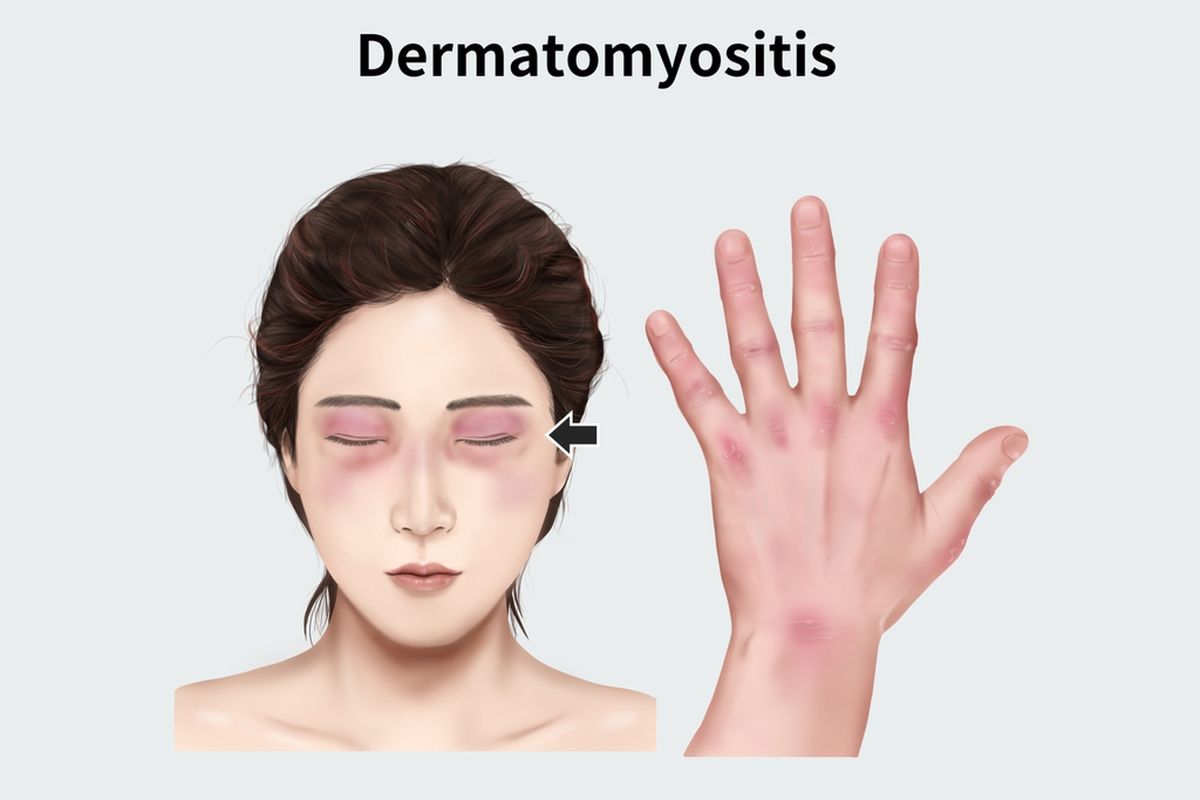 Dermatomiositis