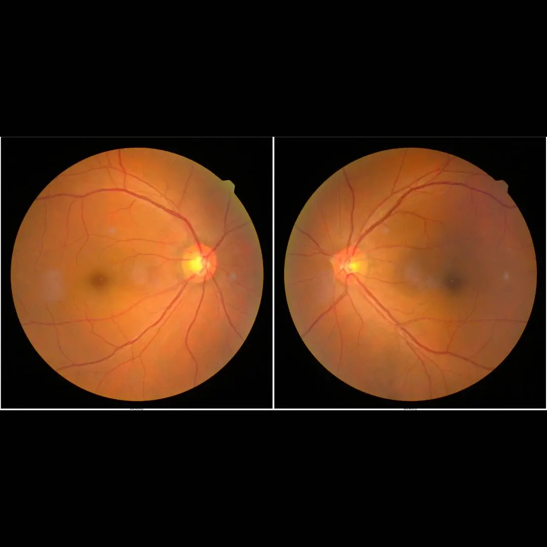 Amaurosis Fugax