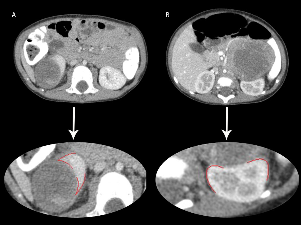 Nephroblastoma