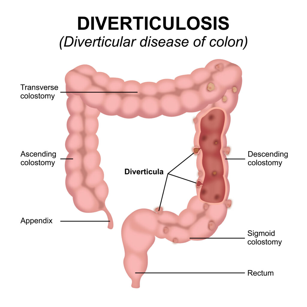 Diverticulosis
