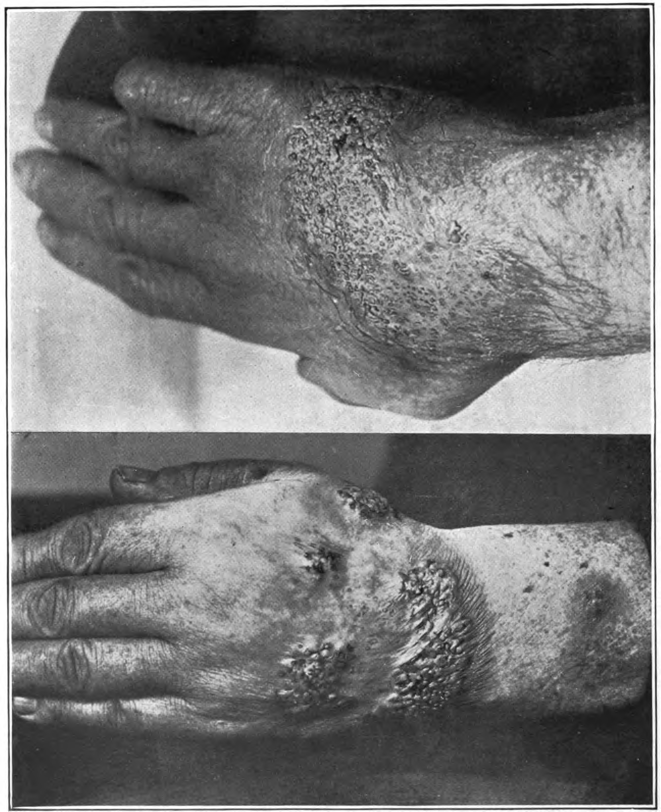 Blastomikosis