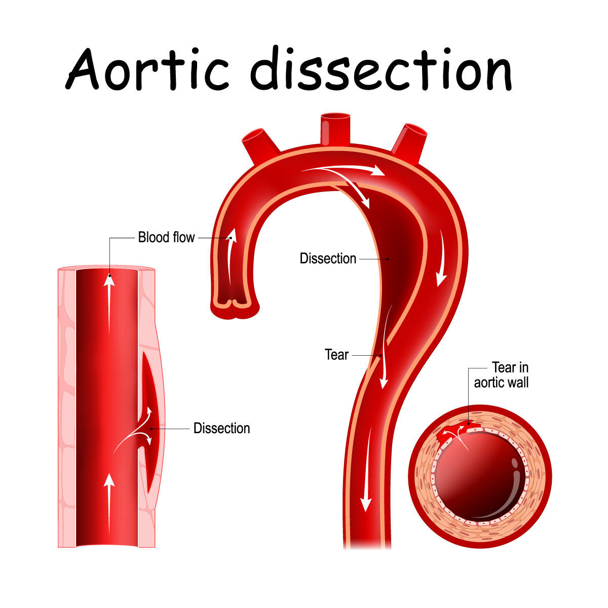 Aortic Dissection