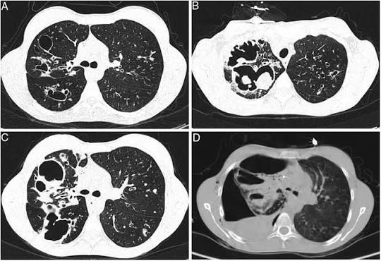 Aspergillosis