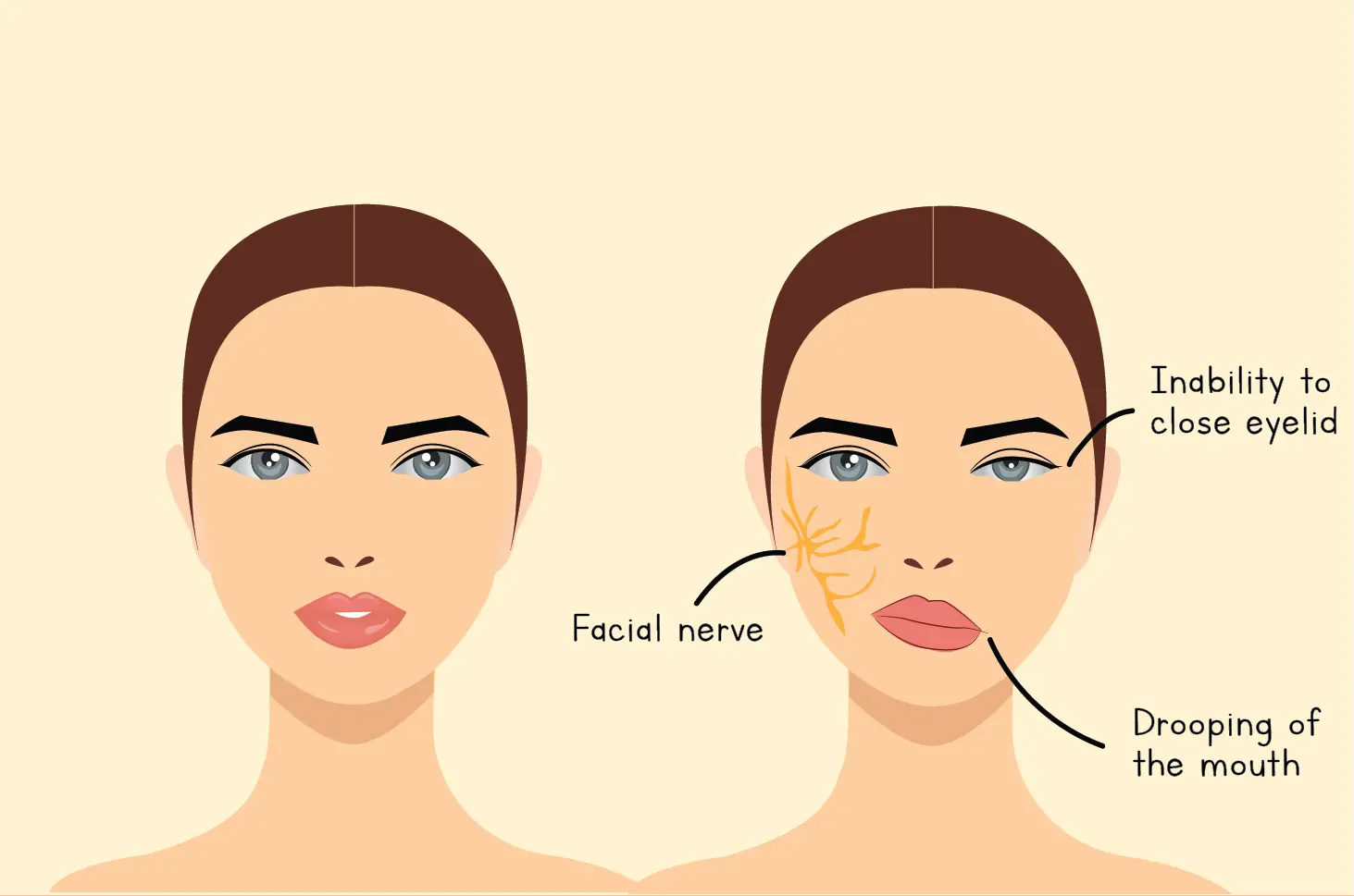 Bell Palsy