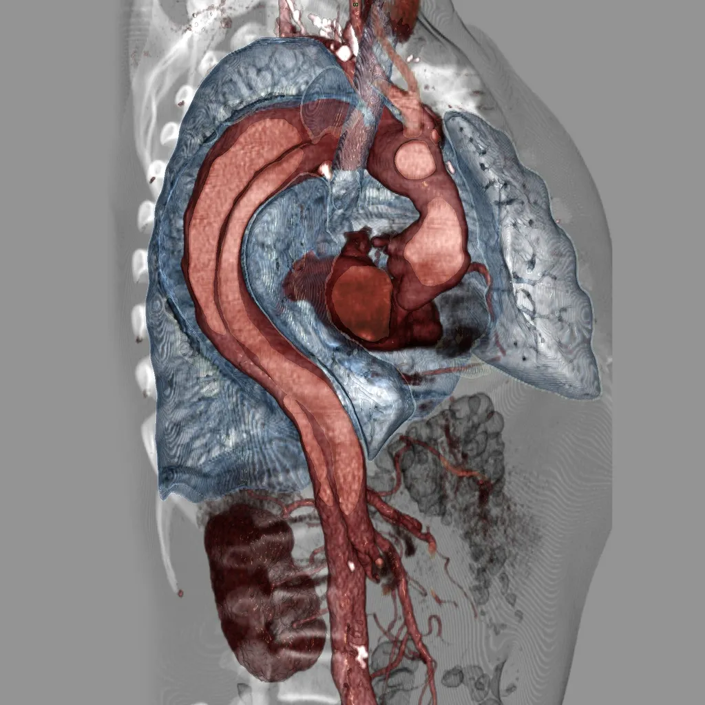 Aortic Dissection