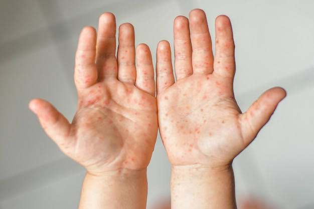 Enterovirus