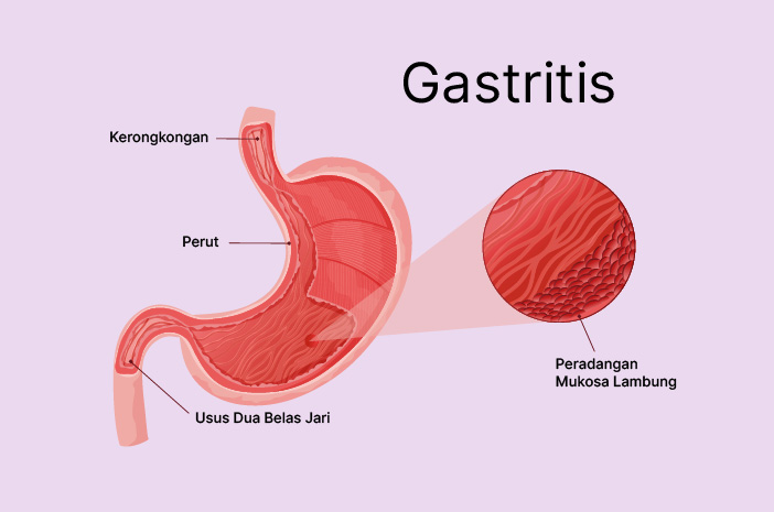 Gastritis Akut
