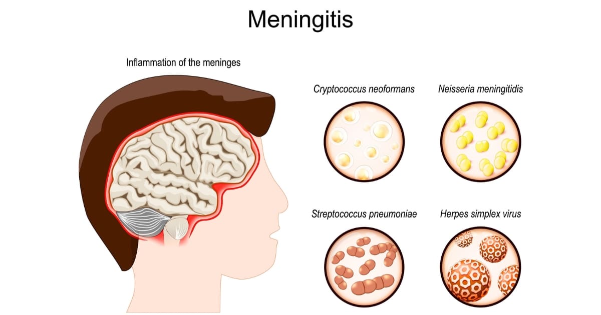 Meningitis Parasit