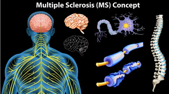 Sklerosis Multipel