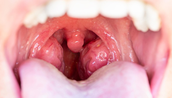 Tonsilitis Akut