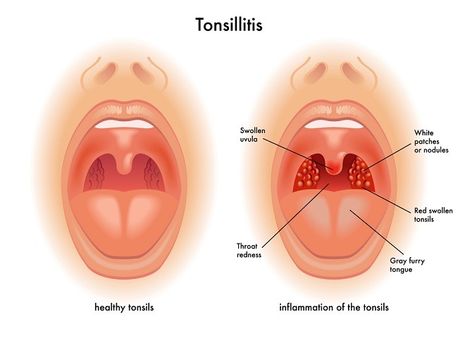 Tonsilitis Akut