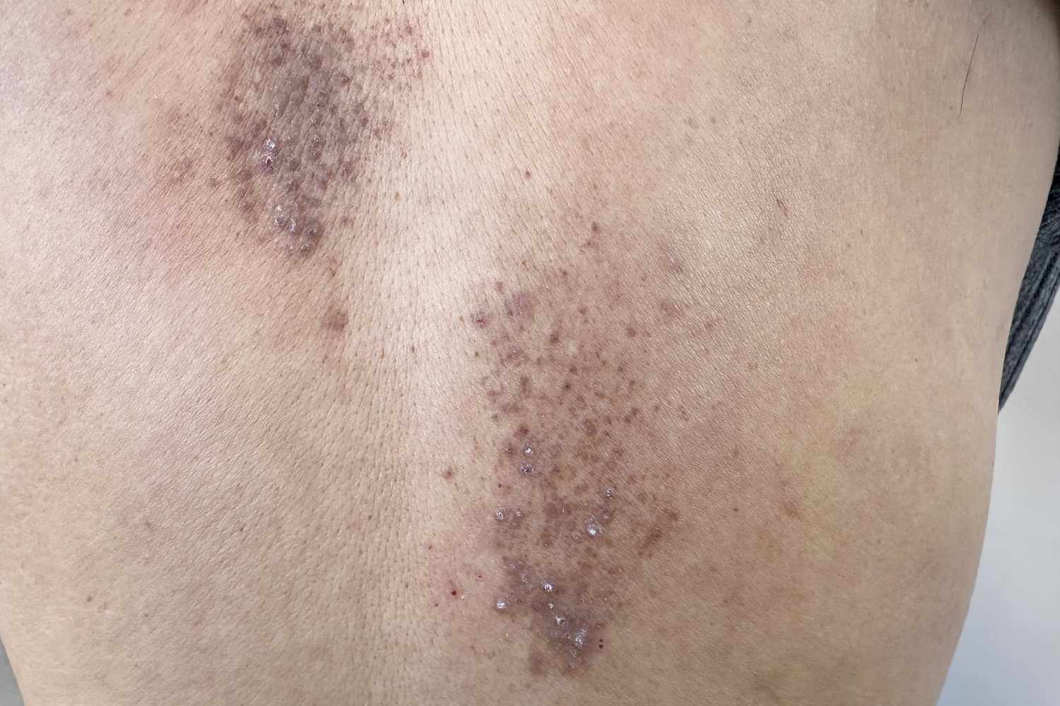 Amiloidosis