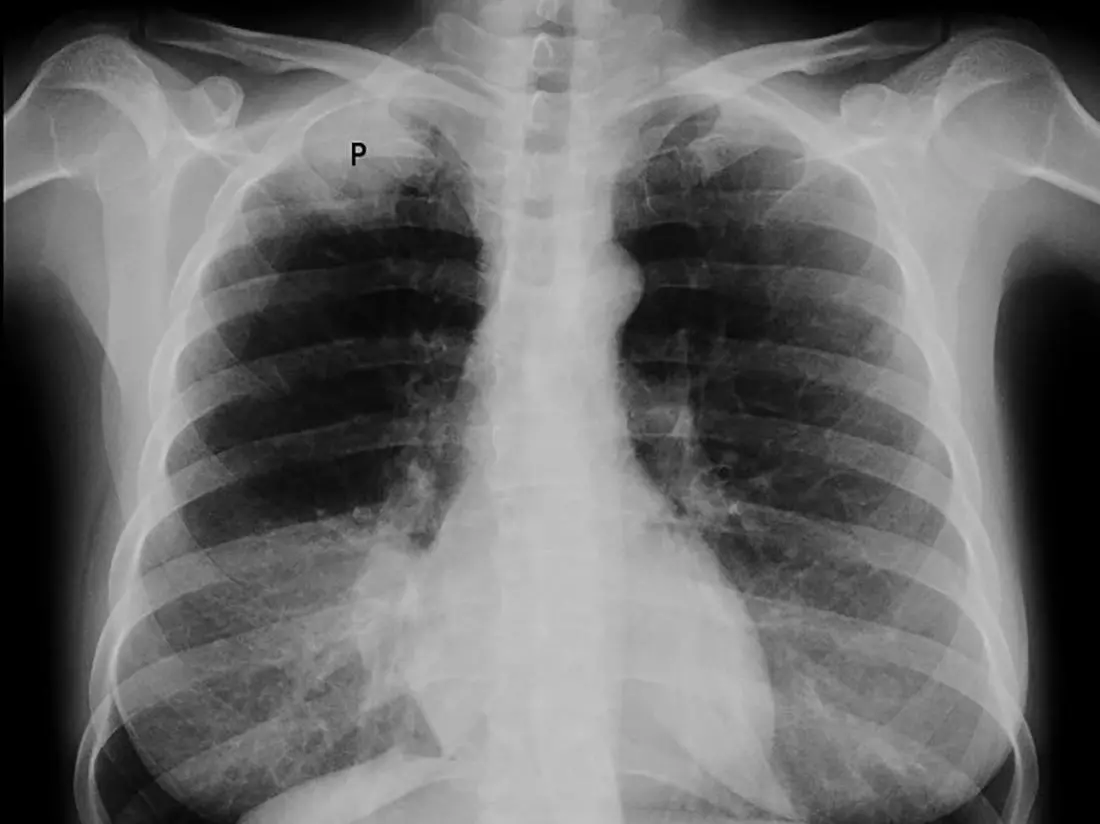 Tumor Pancoast