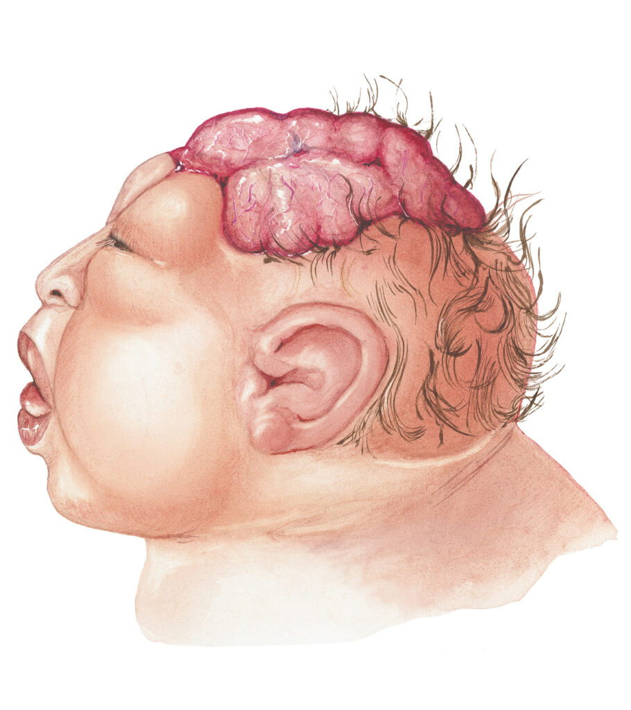 Anensefali