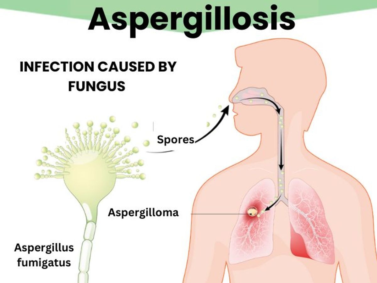 Aspergillosis