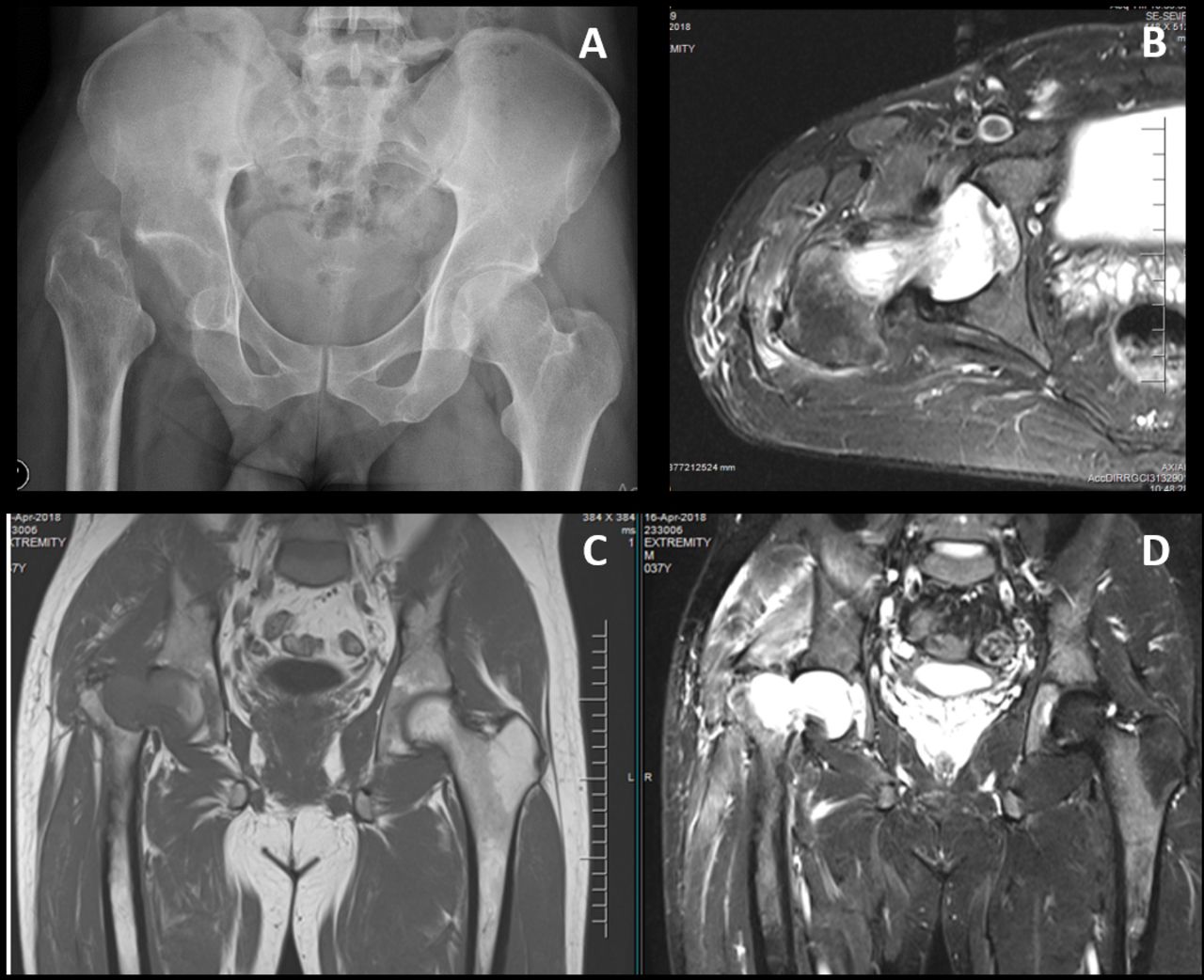 Chondrosarcoma