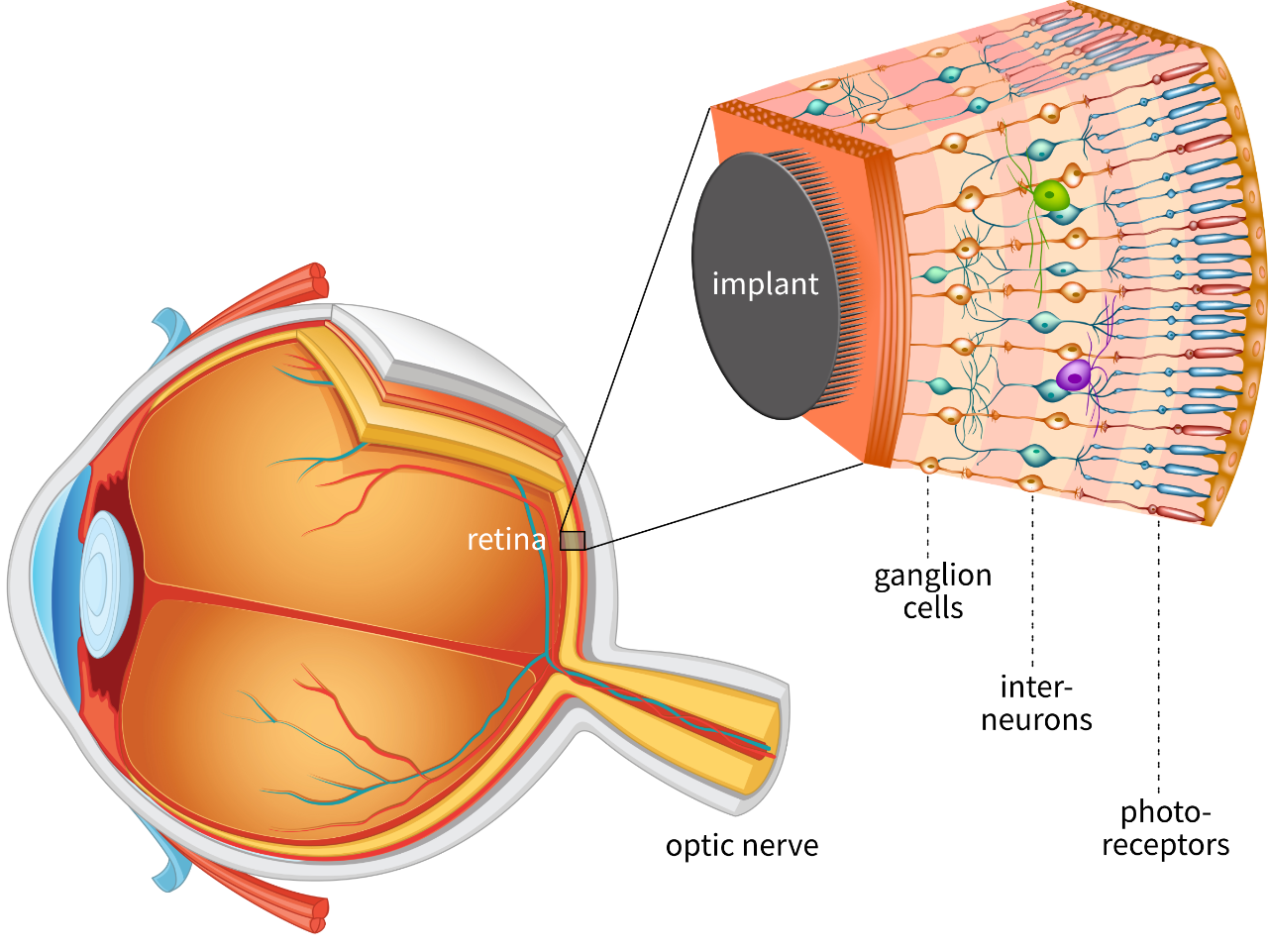 Implan Retina
