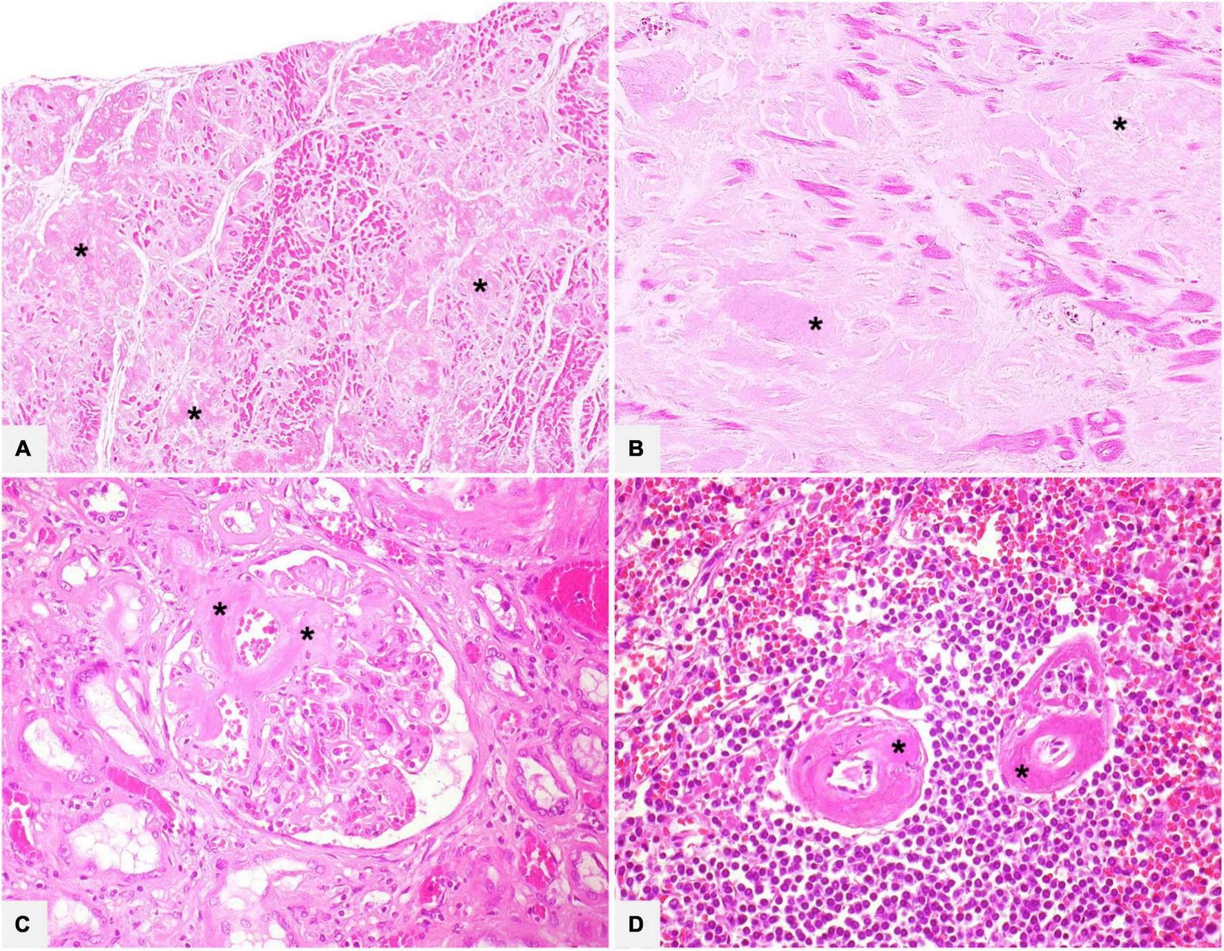 Amiloidosis