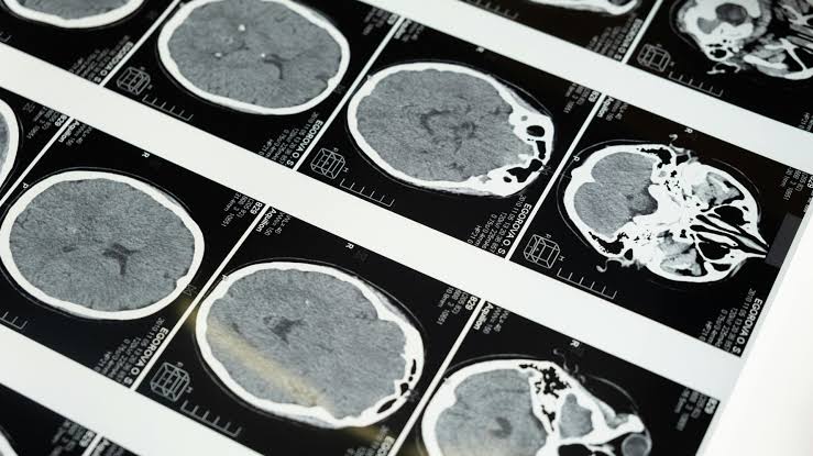 Neuroinflamasi