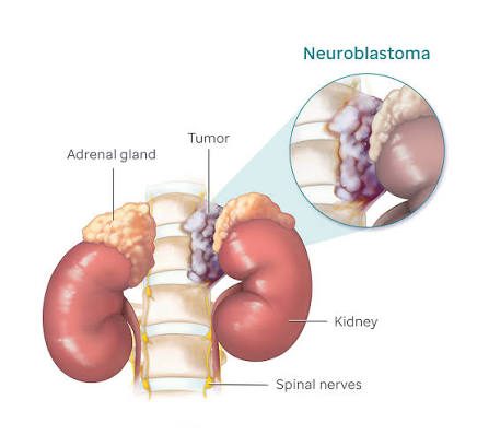 Neuroblastoma