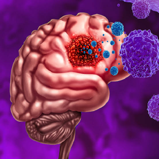 Neuroblastoma