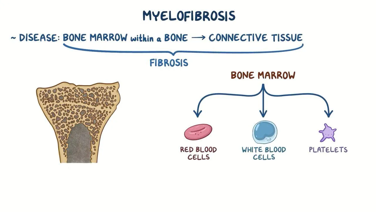 Myelofibrosis
