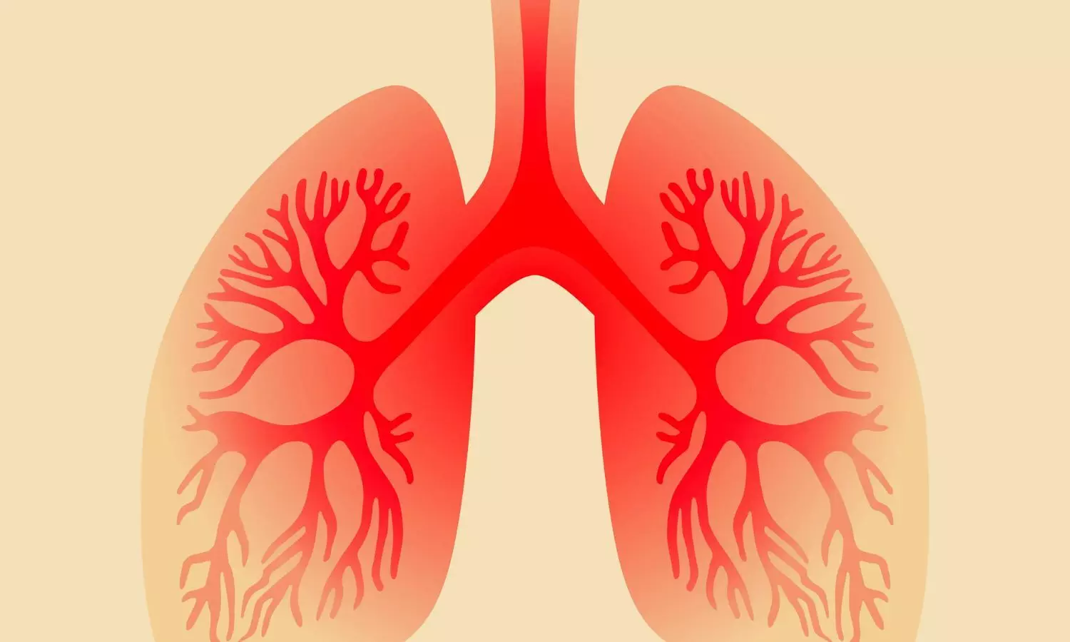 Eosinophilic Asthma