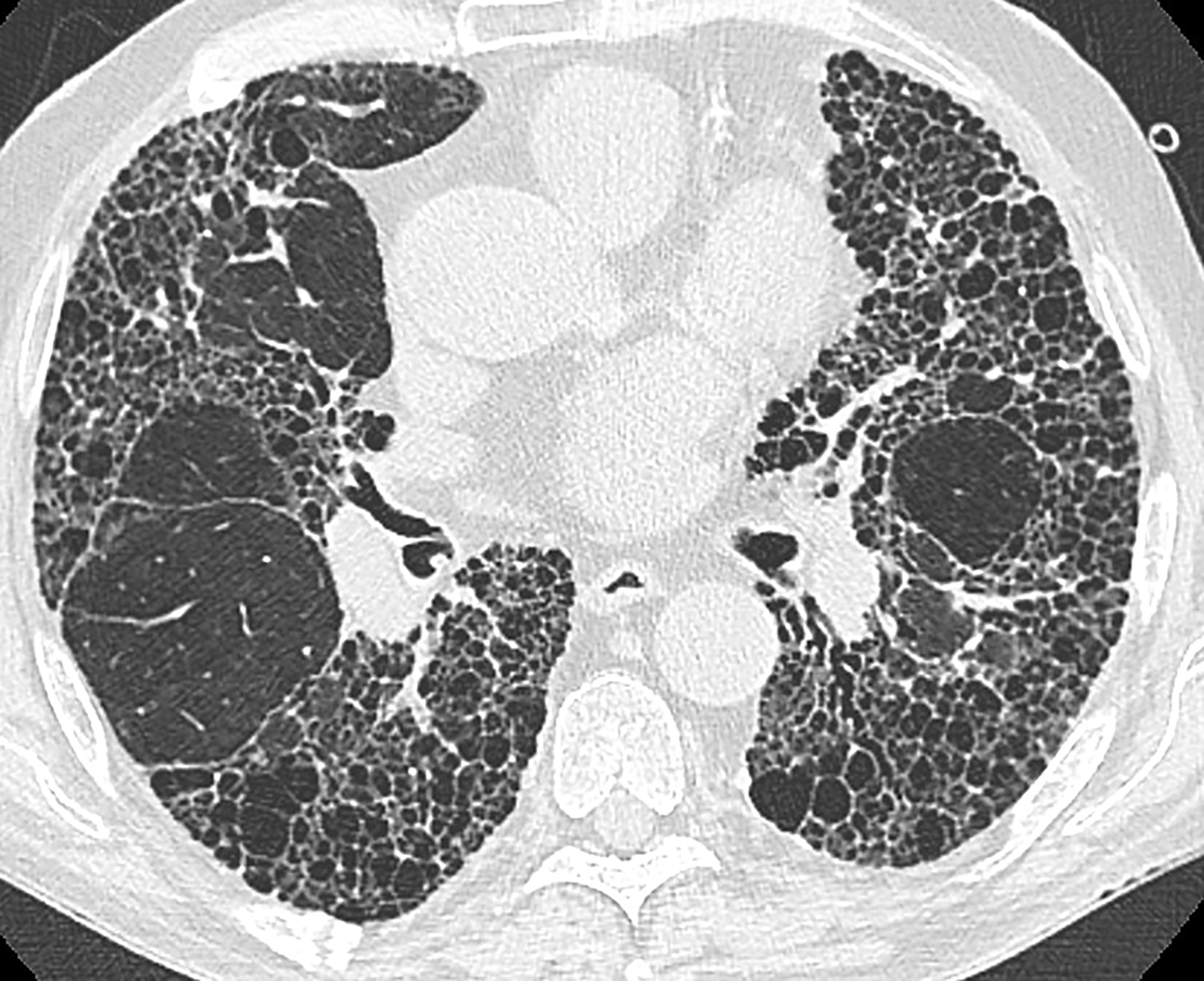 Interstitial Lung Disease