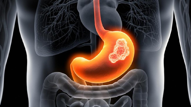 Adenokarsinoma Lambung