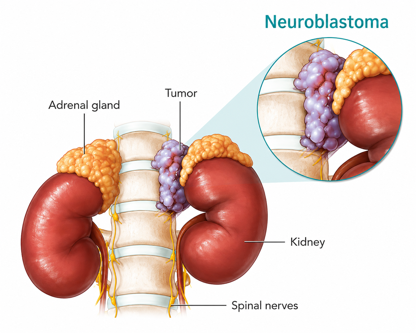 Neuroblastoma