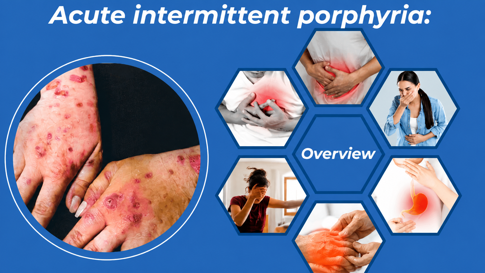 Acute Intermittent Porphyria