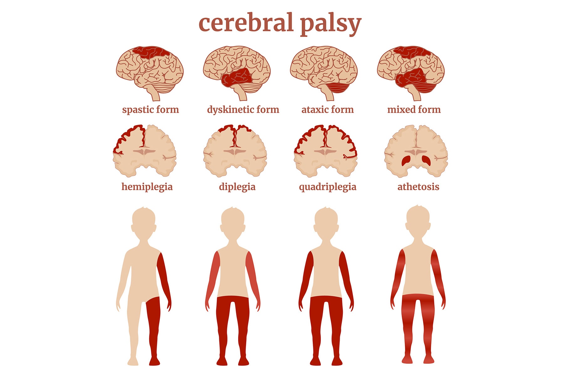 Diplegia