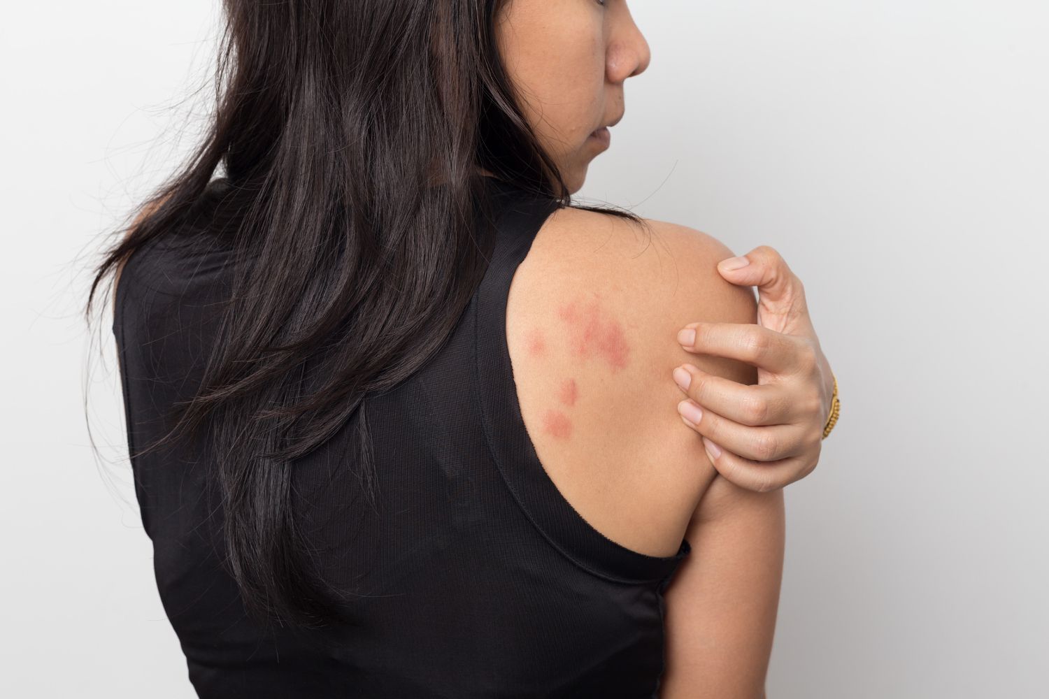 Chronic Urticaria