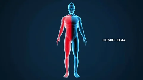 Hemiplegia