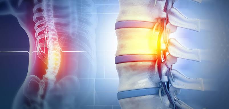 Quadriplegia