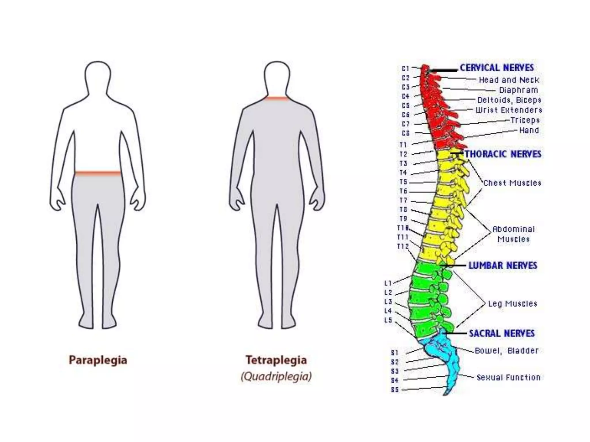 Tetraplegia