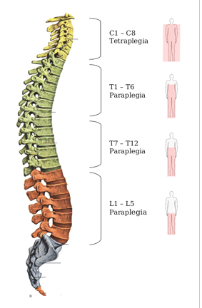 Tetraplegia