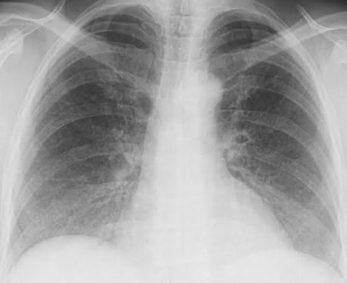 Pneumonitis