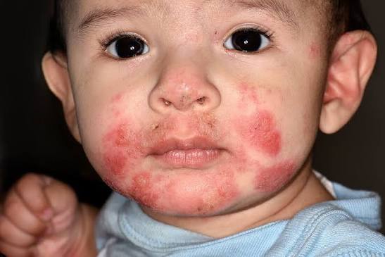 Acrodermatitis Enteropathica