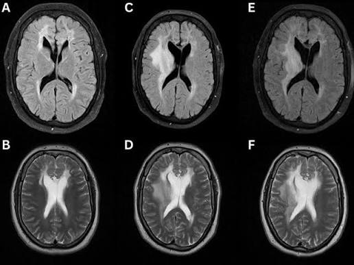 Adrenoleukodystrophy