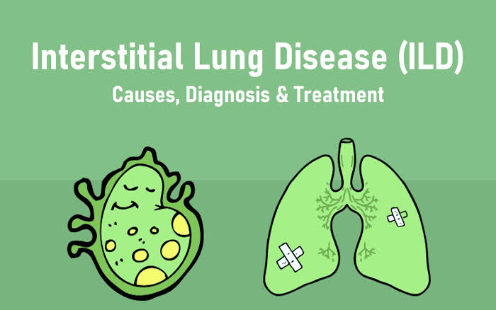 Interstitial Lung Disease