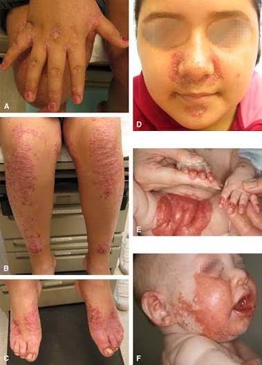 Acrodermatitis Enteropathica
