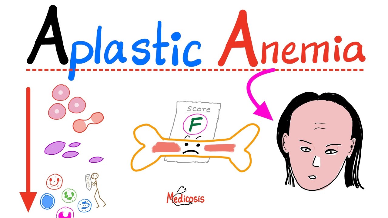 Aplastic Anemia
