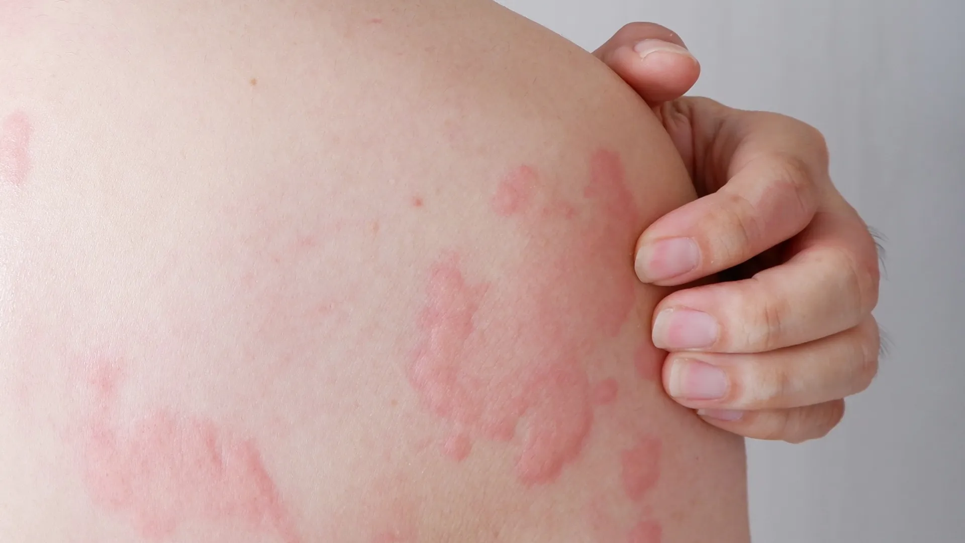 Chronic Urticaria